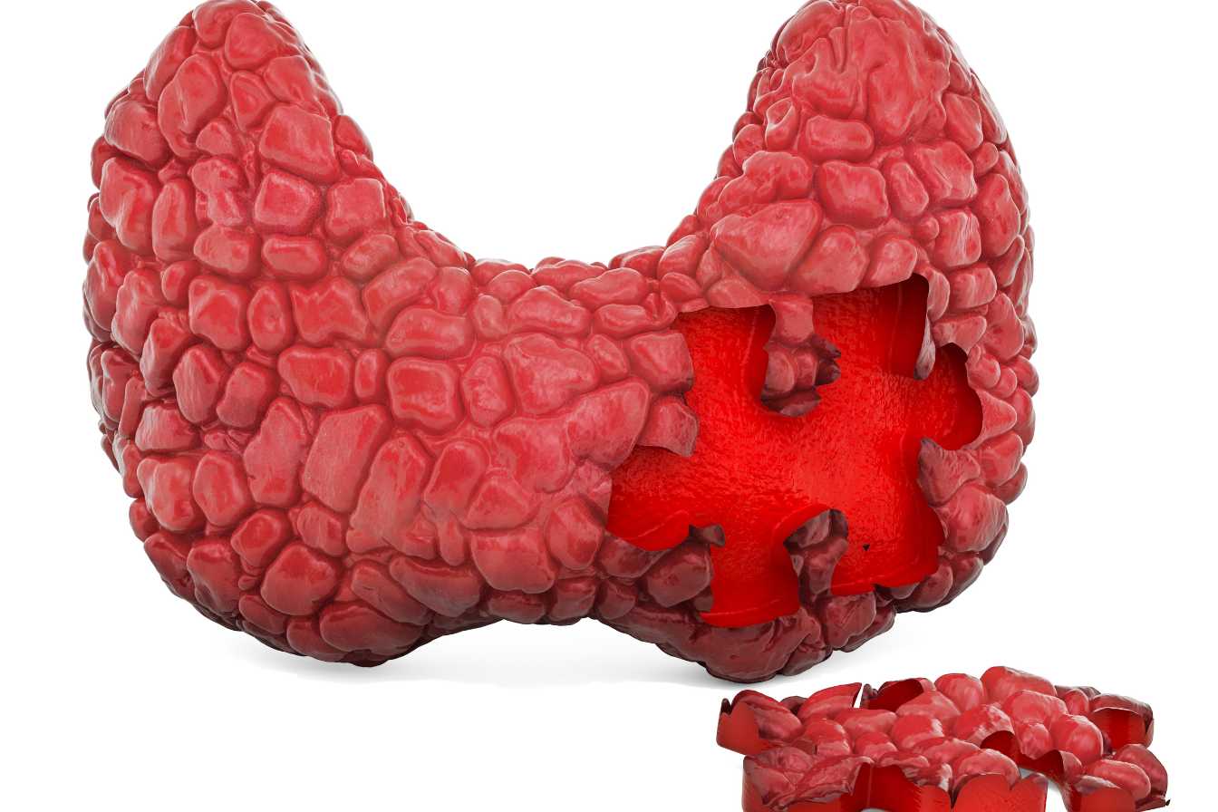 Maladie de Crohn 2