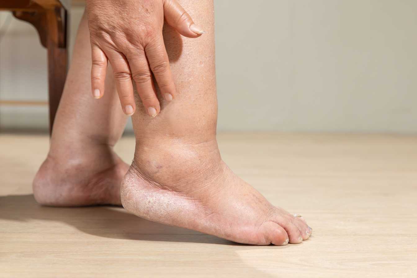 douleur-sur-le-cote-exterieur-du-pied-nerf-sural-3